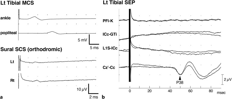 Acute Leriche Syndrome Mimicking Spinal Cord Infarction: A Case Report.