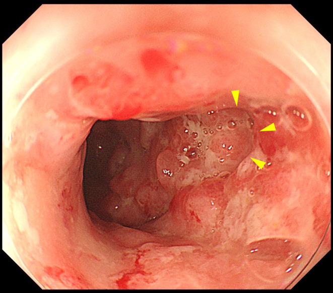 Successful Fistula Closure After Treatment with Colostomy and Infliximab in a Patient with Ulcerative Colitis Complicated by Rectovaginal Fistula.