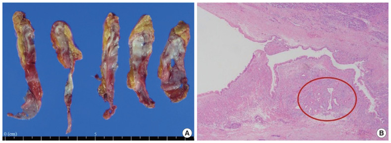 Clinical course of pancreas cancer diagnosed after spleen-preserving distal pancreatectomy with borderline lesion: two case reports.