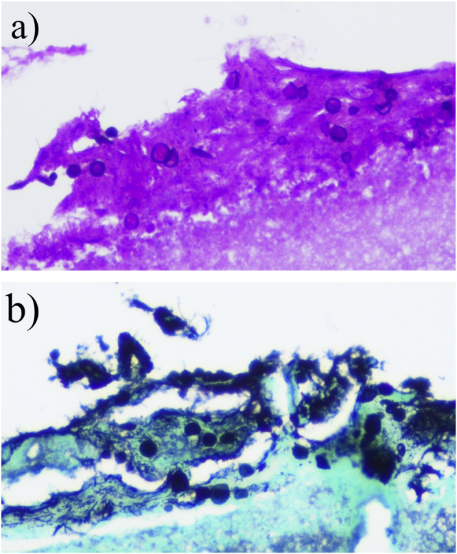 Tracheoesophageal fistula due to Candida and Actinomyces co-infection: A case report and comprehensive review of the literature.