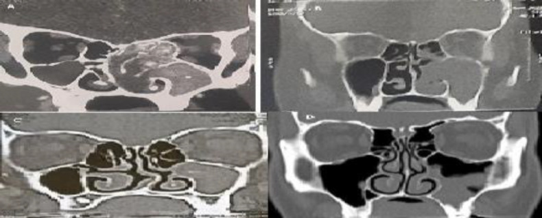 Pediatric Unilateral Chronic Sinusitis: Clinical and Radiological Patterns Compared to Adults.