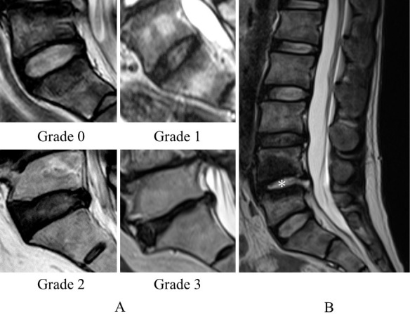 Comparison of Disc Degeneration between Pyogenic Spondylitis and Noninfected Lumbar Spondylosis: A Multicenter Retrospective Study with Propensity Score Matching.