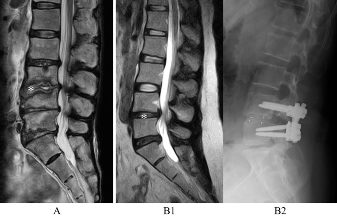 Comparison of Disc Degeneration between Pyogenic Spondylitis and Noninfected Lumbar Spondylosis: A Multicenter Retrospective Study with Propensity Score Matching.