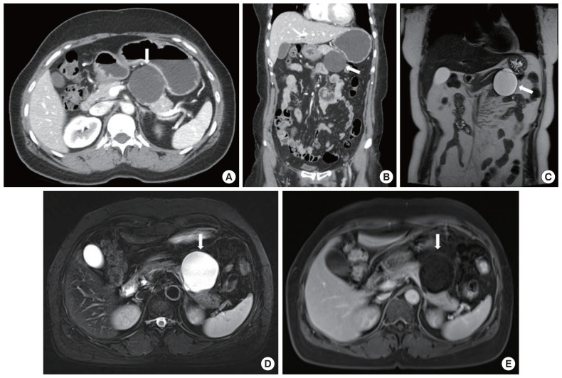 Clinical course of pancreas cancer diagnosed after spleen-preserving distal pancreatectomy with borderline lesion: two case reports.