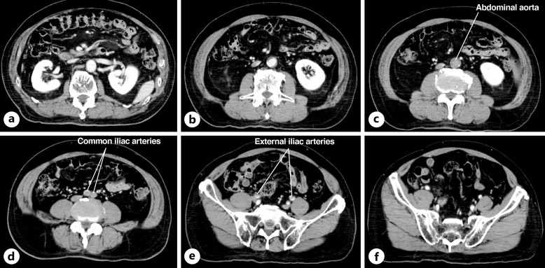 Acute Leriche Syndrome Mimicking Spinal Cord Infarction: A Case Report.