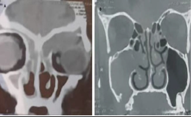 Pediatric Unilateral Chronic Sinusitis: Clinical and Radiological Patterns Compared to Adults.
