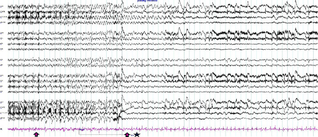 Syncope vs. Seizure: Ictal Bradycardia and Ictal Asystole.