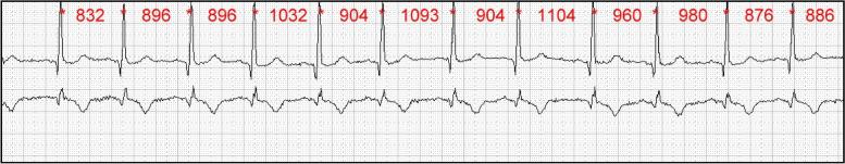 Guideline for the application of heart rate and heart rate variability in occupational medicine and occupational health science.