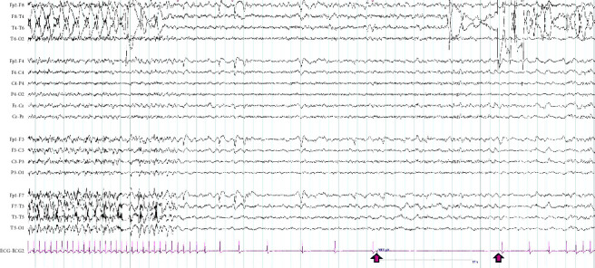 Syncope vs. Seizure: Ictal Bradycardia and Ictal Asystole.
