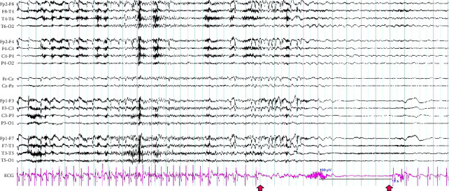 Syncope vs. Seizure: Ictal Bradycardia and Ictal Asystole.
