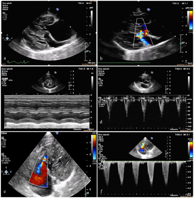 Developmental lung disease in a cat associated with high probability of severe pulmonary hypertension: natural history, histopathology and genetic analysis.