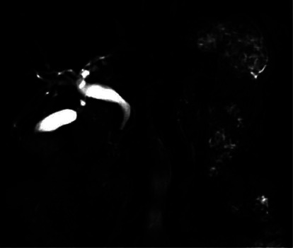 Non-O1, Non-O139 <i>Vibrio cholerae</i> Bacteremia in an Autoimmune Pancreatitis Patient.