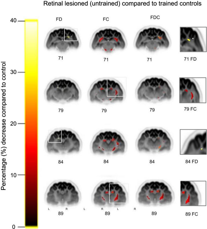 Visual training after central retinal loss limits structural white matter degradation: an MRI study.
