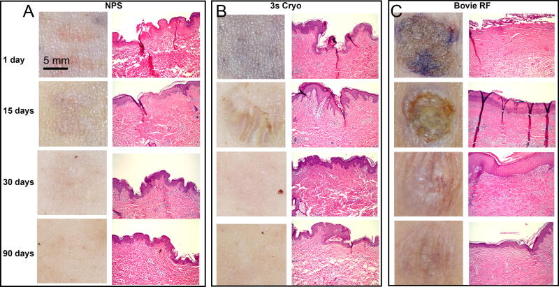 Nano-Pulse Stimulation Therapy Initiates Regulated Cell Death in Skin, Unlike Bovie Radiofrequency Ablation and Cryoablation.