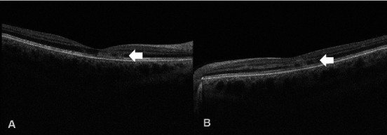 Type II Acute Macular Neuroretinopathy Secondary to Malaria.