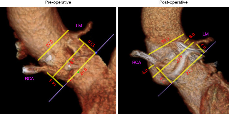 Changes in aortic root dimensions post aortic root enlargement with Y-incision and modified aortotomy.