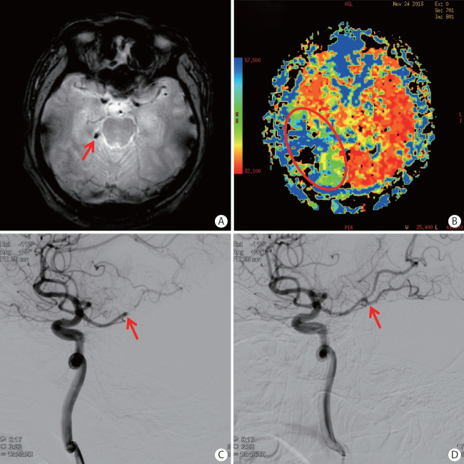 Distal Medium Vessel Occlusion Strokes: Understanding the Present and Paving the Way for a Better Future.
