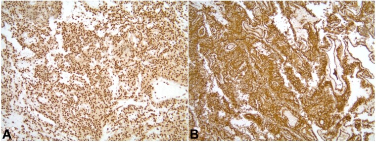 A bleeding heart: case report and review of pericardial angiosarcoma.