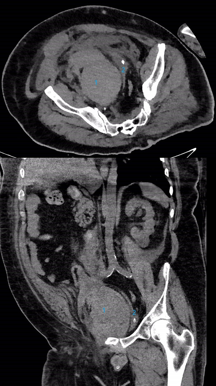 Portable Percussive Massage Device-Related Rectus Sheath Hematoma and Obstructive Uropathy: A Case Report.