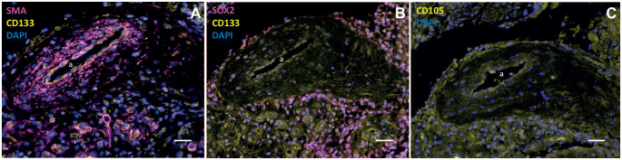 New Insights in ATP Synthesis as Therapeutic Target in Cancer and Angiogenic Ocular Diseases.