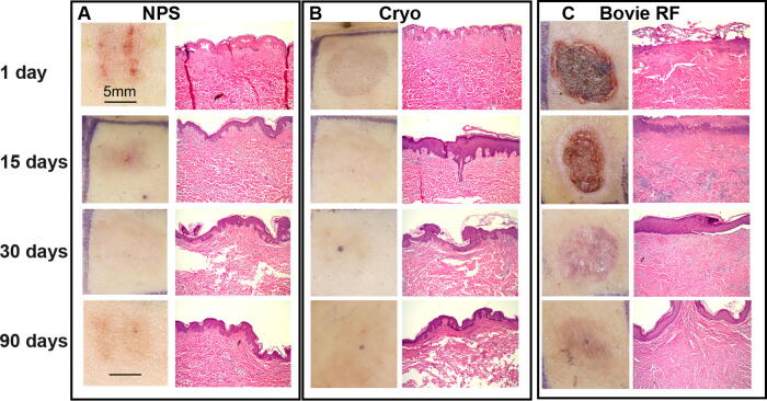 Nano-Pulse Stimulation Therapy Initiates Regulated Cell Death in Skin, Unlike Bovie Radiofrequency Ablation and Cryoablation.