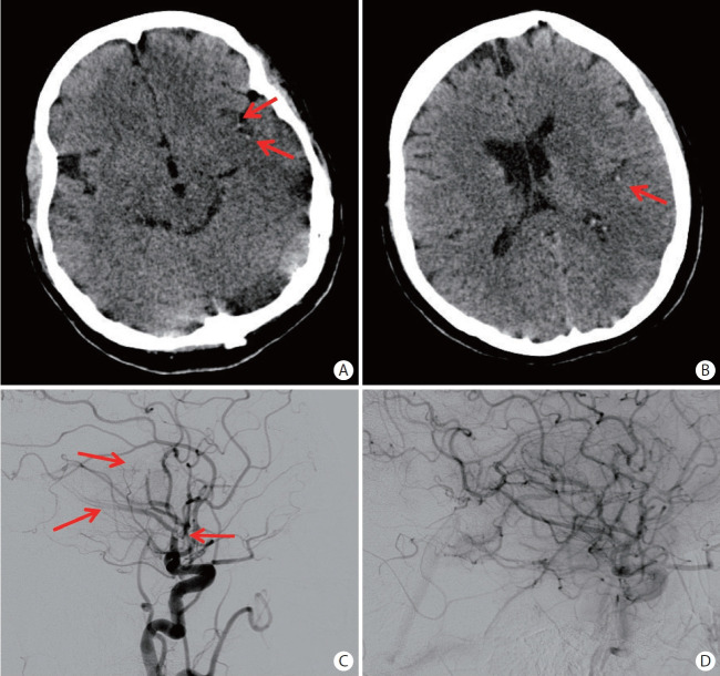 Distal Medium Vessel Occlusion Strokes: Understanding the Present and Paving the Way for a Better Future.