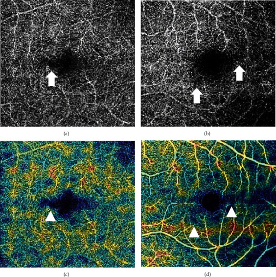 Type II Acute Macular Neuroretinopathy Secondary to Malaria.