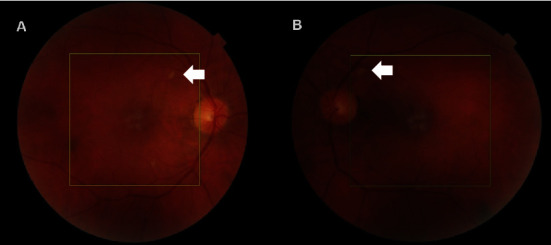 Type II Acute Macular Neuroretinopathy Secondary to Malaria.