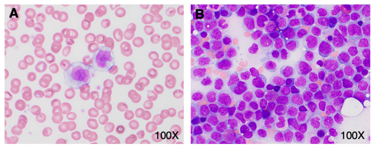 Morphological Clues of Acute Monocytic Leukemia in COVID-19-Induced Transient Leukoerythroblastic Reaction with Monocytosis.