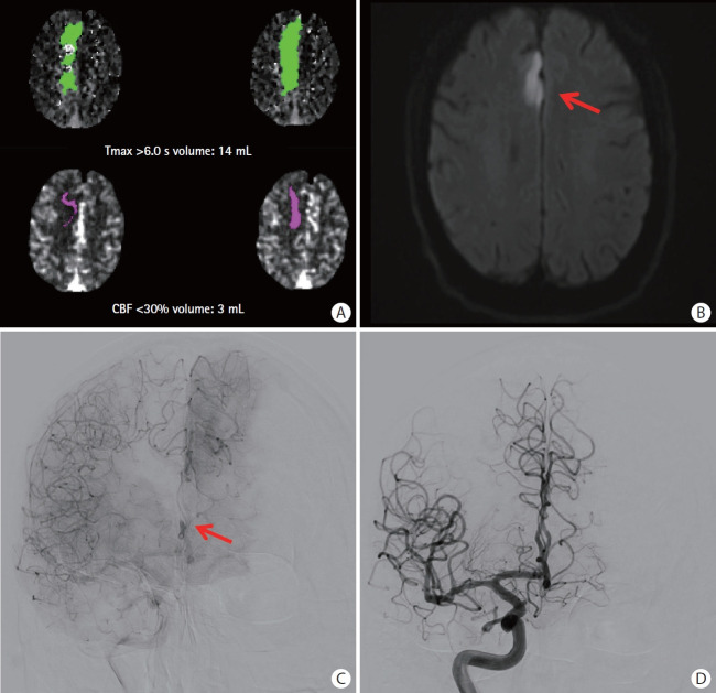 Distal Medium Vessel Occlusion Strokes: Understanding the Present and Paving the Way for a Better Future.