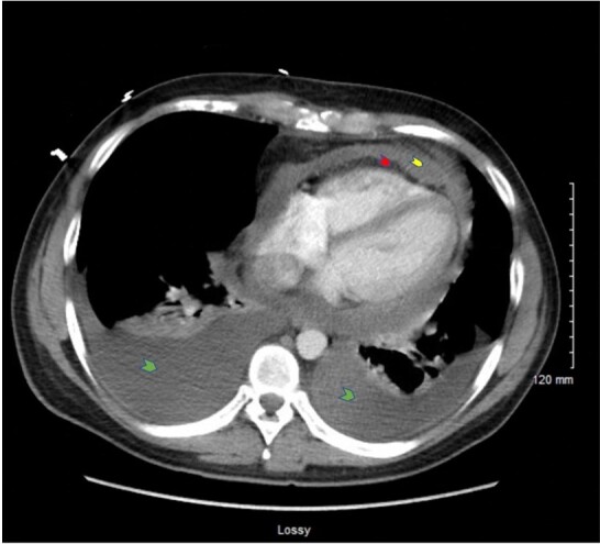 A bleeding heart: case report and review of pericardial angiosarcoma.