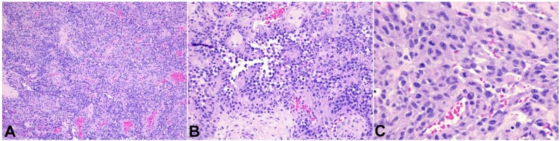 A bleeding heart: case report and review of pericardial angiosarcoma.