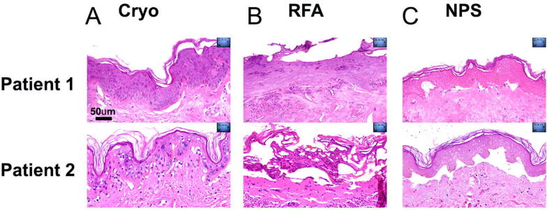 Nano-Pulse Stimulation Therapy Initiates Regulated Cell Death in Skin, Unlike Bovie Radiofrequency Ablation and Cryoablation.