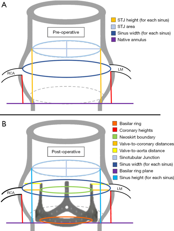 Changes in aortic root dimensions post aortic root enlargement with Y-incision and modified aortotomy.