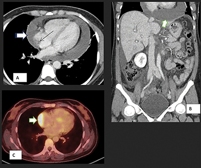 Unusual Finding in a Patient Presenting with Abdominal Pain and Dyspnea.
