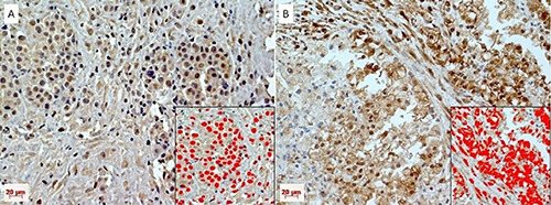 Pleural mesothelioma from fluoro-edenite exposure: PACAP and PAC1 receptor. A preliminary report.