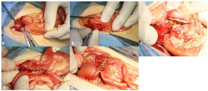 Choledochoduodenostomy combined with Billroth II procedure for extrahepatic biliary obstruction and duodenal perforation in a cat.