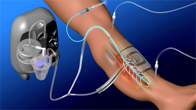 Management of open fracture and related complications: the Japanese way.