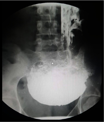 Delayed Diagnosis of Congenital Duodenal Stenosis in a 16-Year-Old Girl.