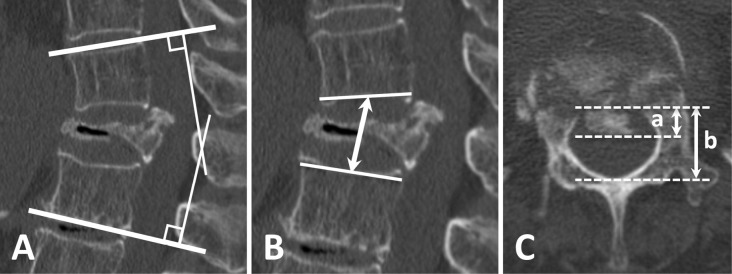 Indirect Decompression in Vertebral Reconstruction for Osteoporotic Vertebral Fractures with Neurological Symptoms: A Preliminary Case Series.