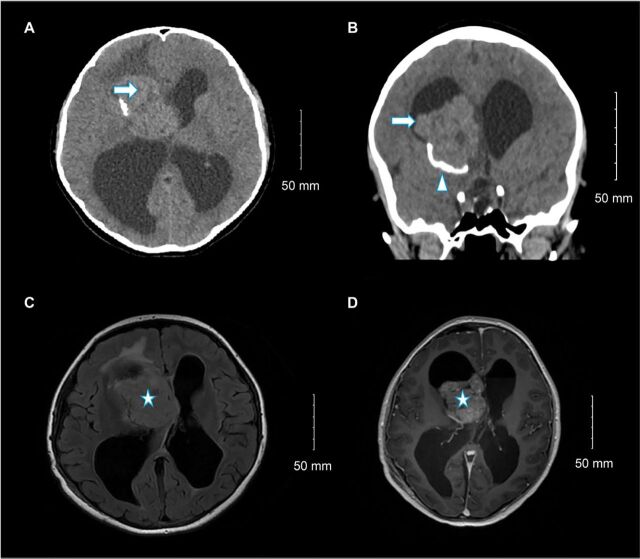 Sporadic subependymal giant cell astrocytoma with somatic <i>TSC2</i> mutation: A case report.