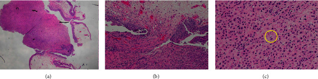 Rectal Stricture Caused by a Rare Plasmacytoid Urothelial Carcinoma.