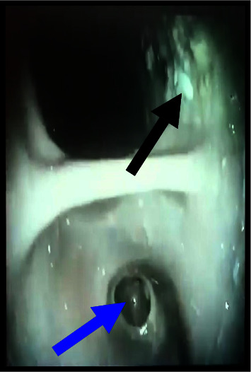 Delayed Diagnosis of Congenital Duodenal Stenosis in a 16-Year-Old Girl.
