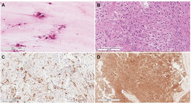 Sporadic subependymal giant cell astrocytoma with somatic <i>TSC2</i> mutation: A case report.
