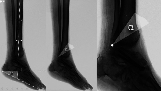 Oblique Dorsiflexion Osteotomy of the Distal Tibia for Fixed Ankle Equinus: Surgical Technique.