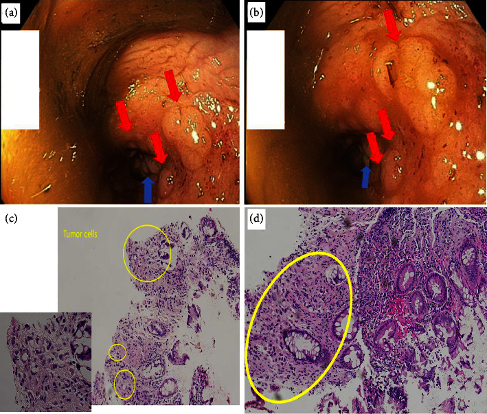 Rectal Stricture Caused by a Rare Plasmacytoid Urothelial Carcinoma.