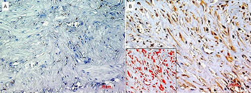 Pleural mesothelioma from fluoro-edenite exposure: PACAP and PAC1 receptor. A preliminary report.