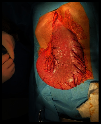 Delayed Diagnosis of Congenital Duodenal Stenosis in a 16-Year-Old Girl.