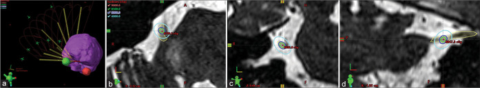Frameless image-guided linear accelerator (LINAC) stereotactic radiosurgery for medically refractory trigeminal neuralgia: Clinical outcomes in 116 patients.