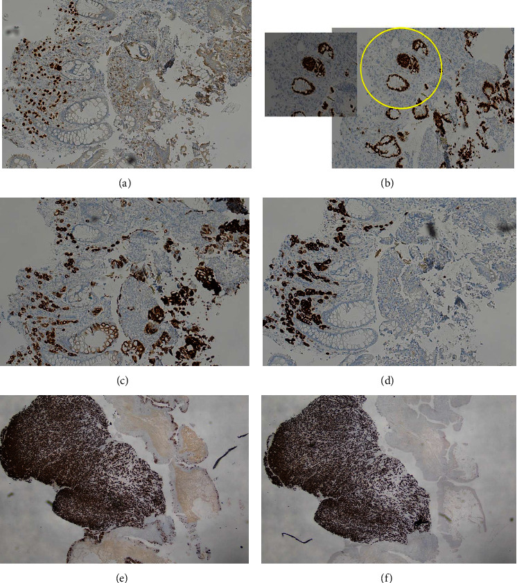 Rectal Stricture Caused by a Rare Plasmacytoid Urothelial Carcinoma.